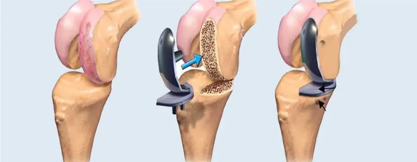 Types of Joint Replacement Surgeries Commonly Done in India